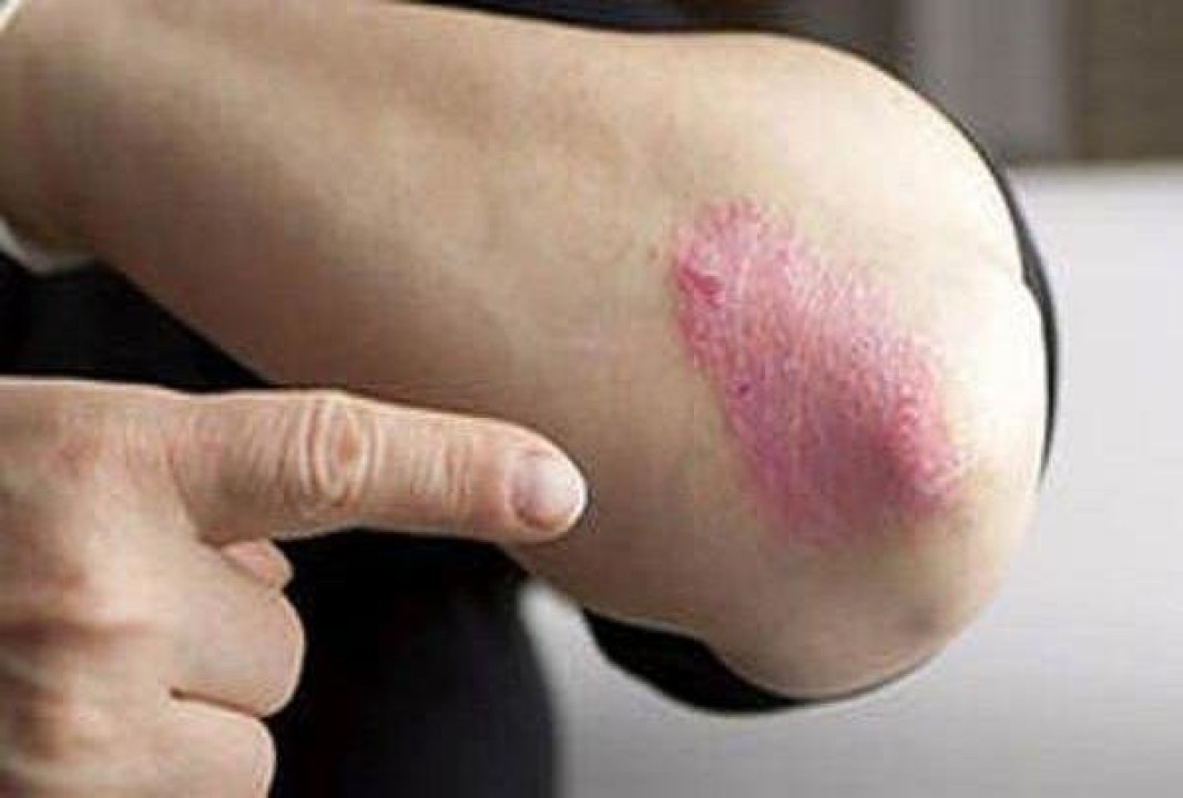 با بیماری پسوریازیس و علائم آن آشنا شوید با بیماری پسوریازیس و علائم آن آشنا شوید